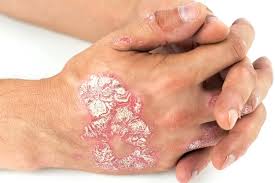 Psoriasis image 1