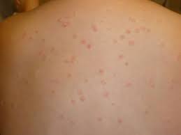 Psoriasis image 2