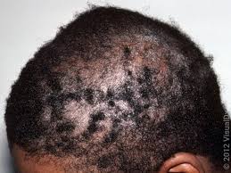 Psoriasis image 3